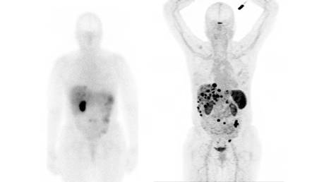 Both images are scans of the same neuroendocrine cancer patient. The one on the left uses the former detection methods available in our region, while the right scan uses the gallium-68 DOTATATE tracer; donor-funded technology now available at the QEII. Contributed